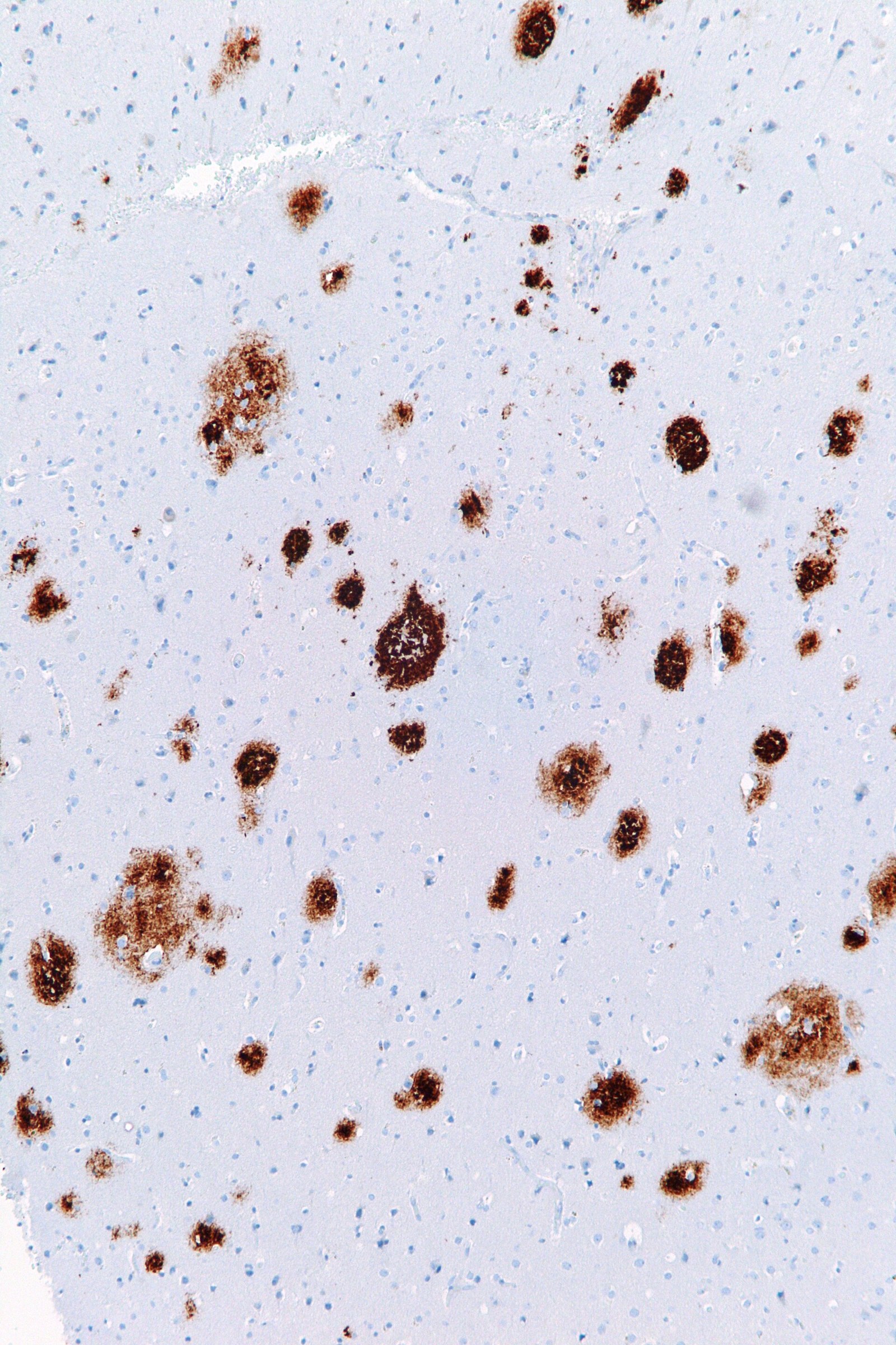 Micrografía histológica con depósitos de beta amiloide en tejido cerebral.