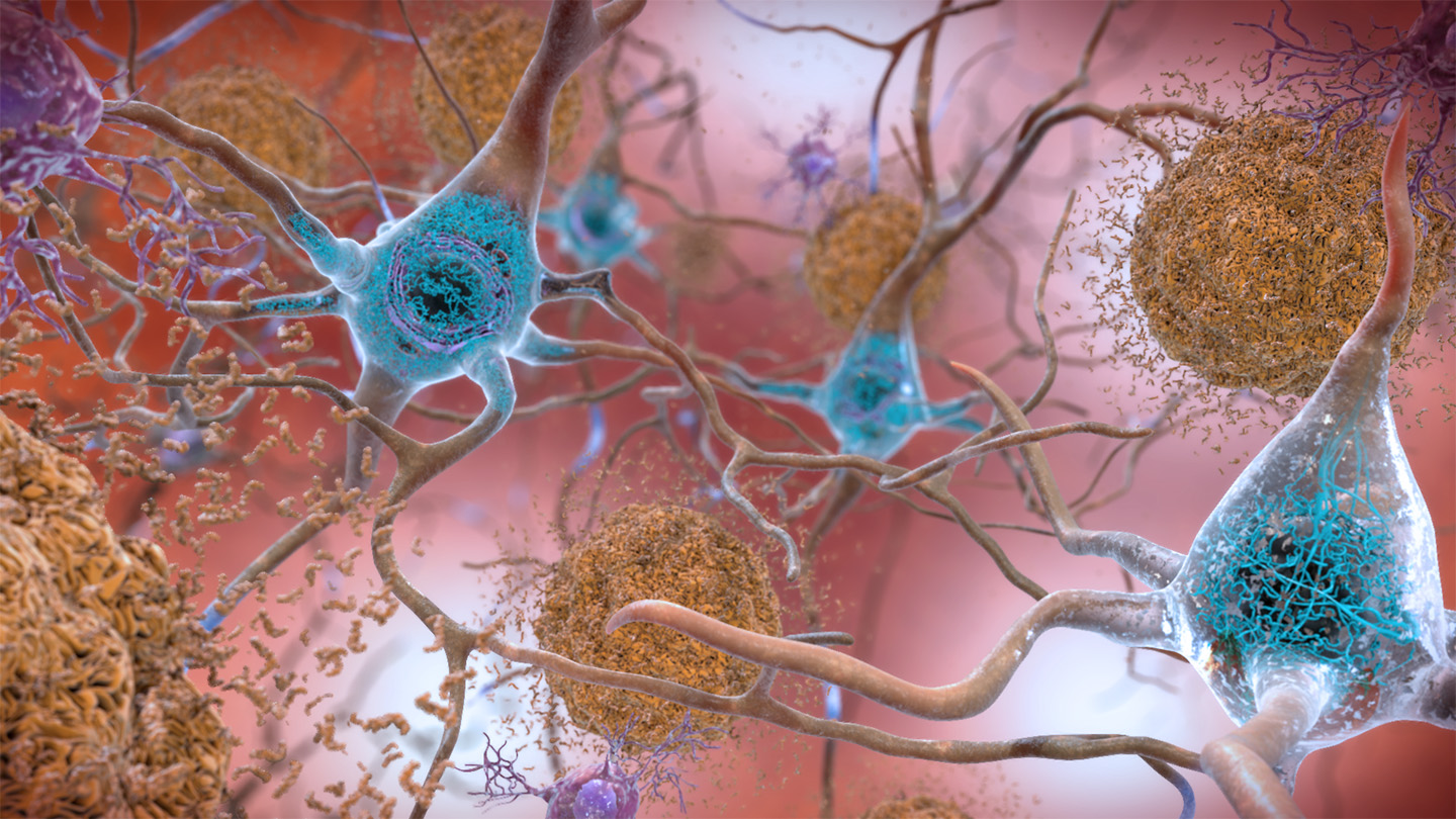 Ilustración de agregados de tau y placas amiloides asociadas a la enfermedad de Alzheimer.