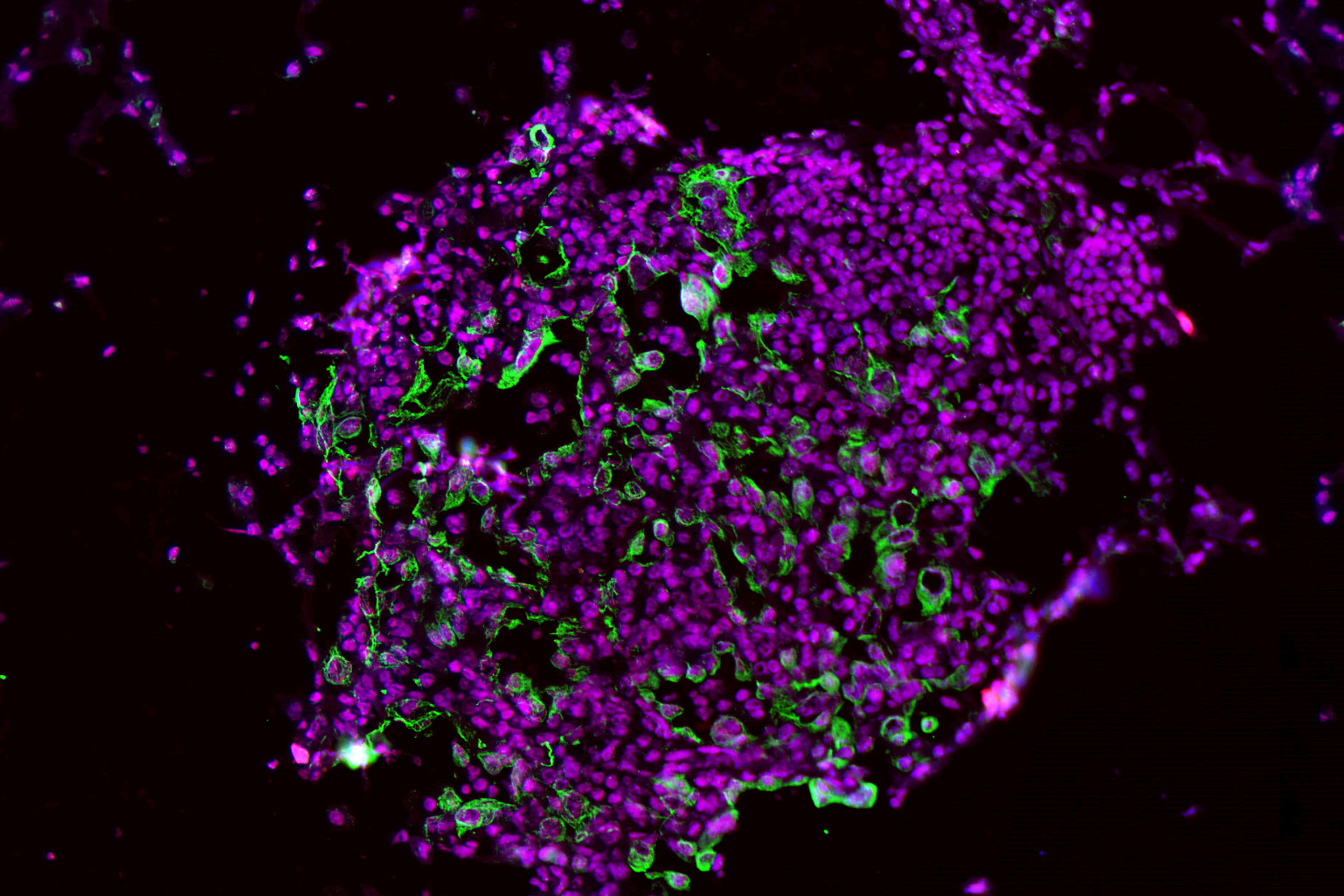 Micrografía de células tumorales pulmonares con señales fluorescentes que muestran alta actividad de caspasa-1.
