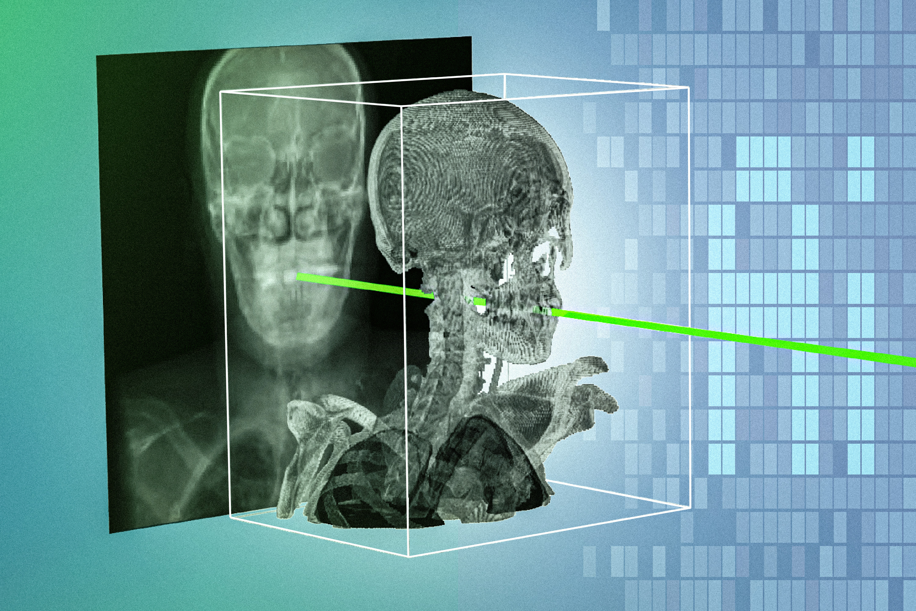 Radiografía y reconstrucción 3D de la columna alineadas dentro de un volumen con líneas de registro.