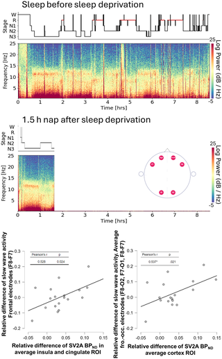 Mapas cerebrales y gráfico del estudio que muestran cambios en un marcador de actividad sináptica después de una noche sin dormir