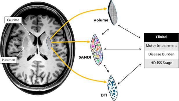 Esquema del estudio que compara mediciones de densidad de soma y neuritas en núcleos profundos del cerebro afectados por la enfermedad de Huntington.